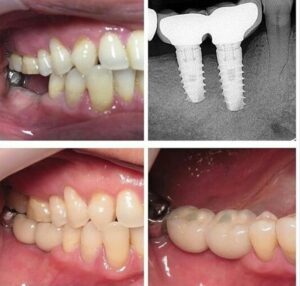 Dental Implant In Bangalore