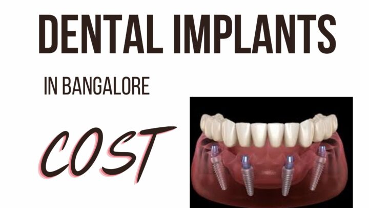 Cost Of Dental Implant In Bangalore