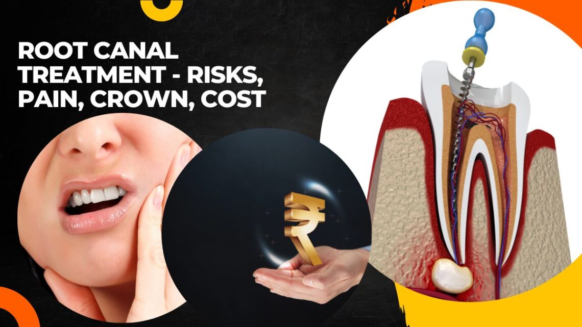 Root Canal Treatment – Risks, Pain, Crown, Cost