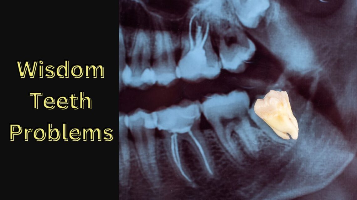 Wisdom Teeth Problems